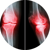 Knee pain - osteoarthritis
