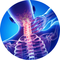 Arthritis - osteoporosis